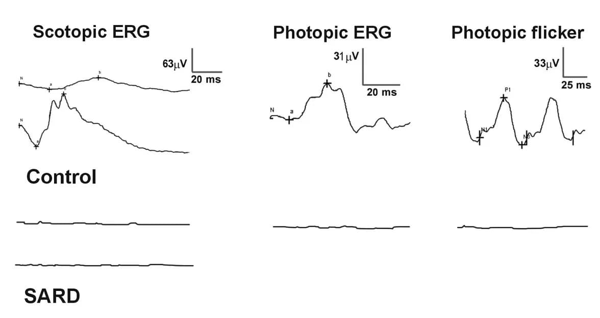 Electroretinography (ERG) recording from a dog with SARDS