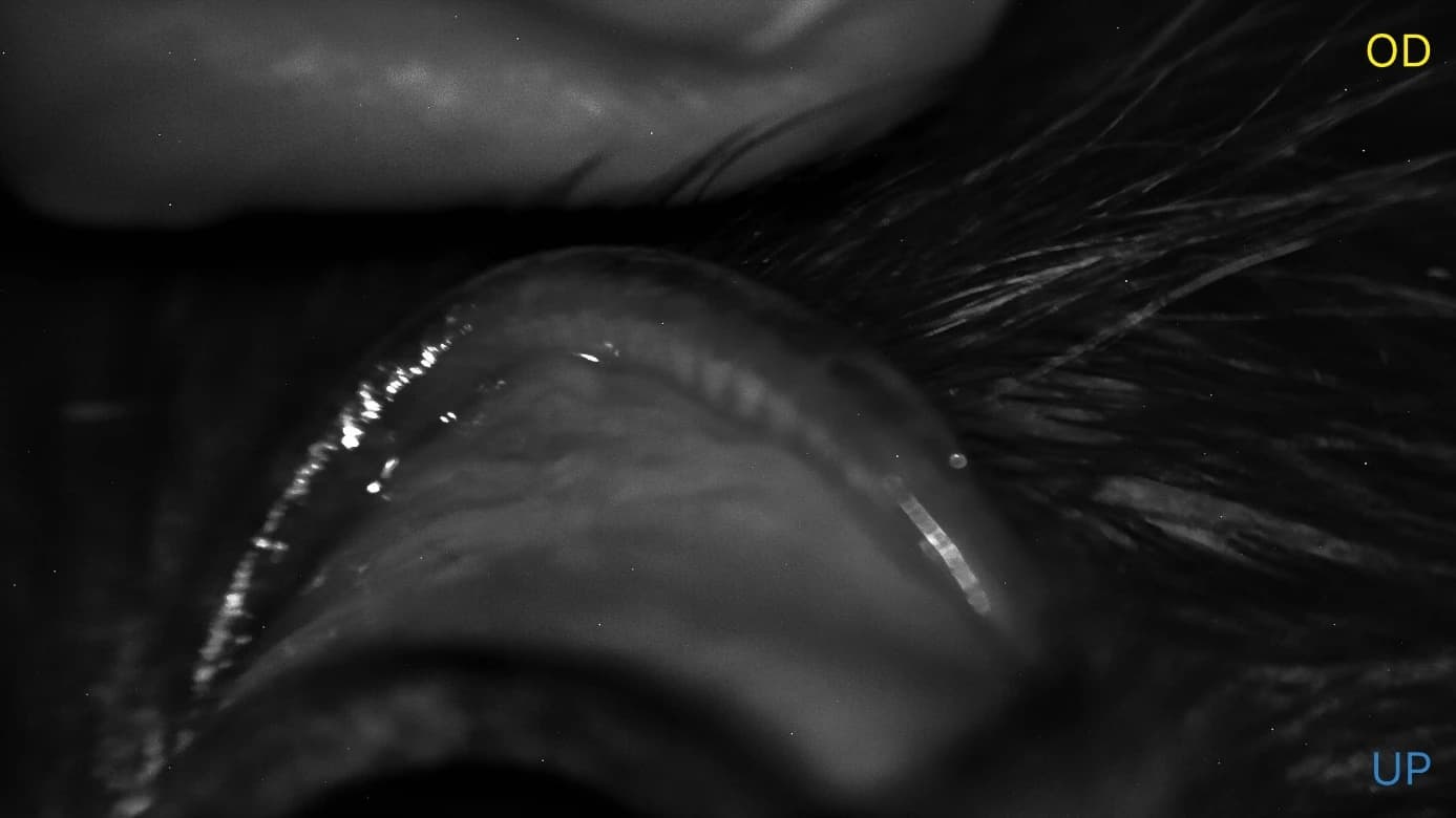 Additional Meibomian gland imaging