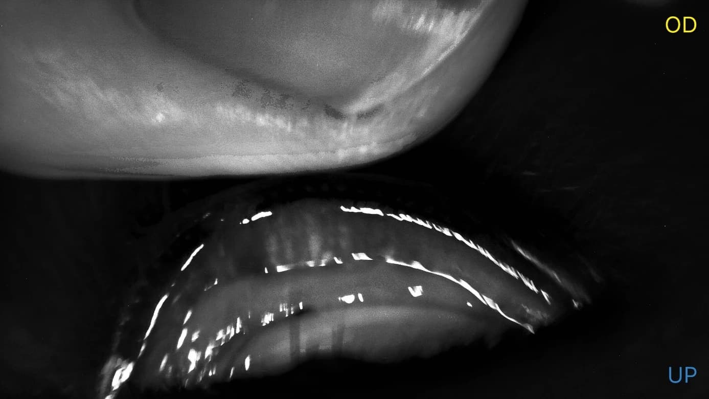 Meibomiography (Meibomian Gland Evaluation)