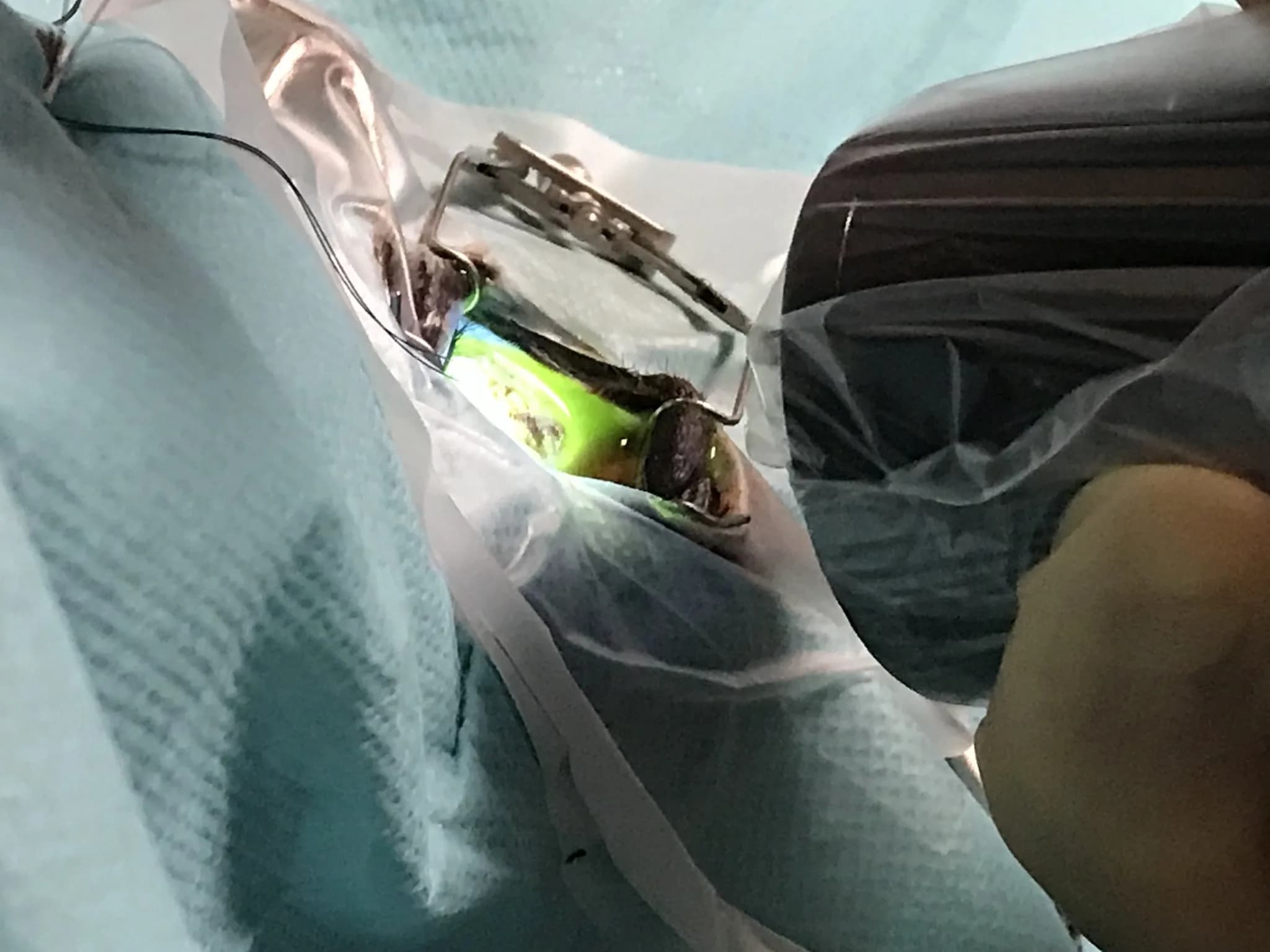 Corneal cross-linking performed under an operating microscope