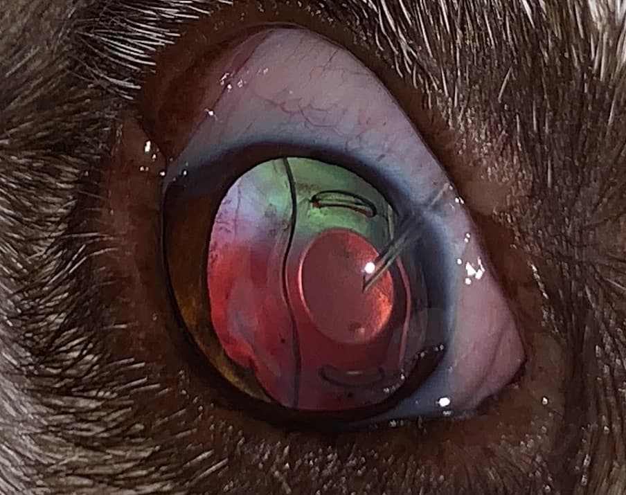 Close-up of an eye during glaucoma surgery