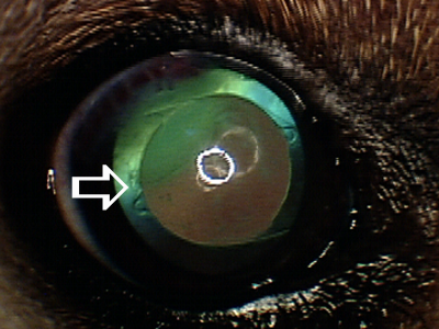 Artificial lens placed after cataract removal