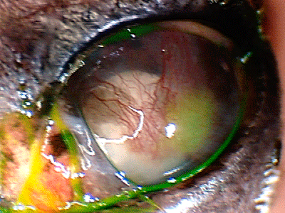 Chronic cataract with inflammation and corneal ulcer