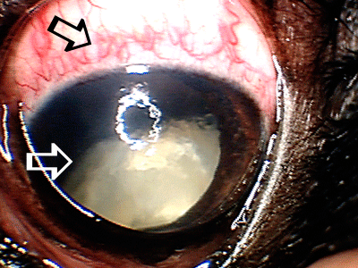 Long-standing cataract that led to glaucoma