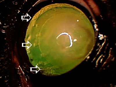 Early cataracts